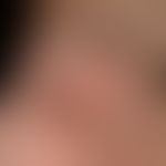 Psoriasis palmaris et plantaris (plaque type): A minus variant with affection of the acral thumb ...