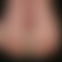 Psoriasis palmaris et plantaris (plaquet type): chronic stationary keratotic plaques on the soles...