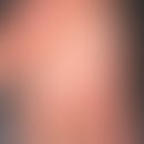 Psoriasis pustulosa palmaris et plantaris. Akuter Schub, flächiges Erythem mit isolierten und kon...