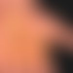 psoriasis palmaris et plantaris (plaque type): chronic inpatient type. deeply drawn hand lines. t...