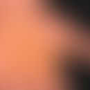 Psoriasis palmaris et plantaris (Plaquetyp): Erklärungen s. folgende Abbildung.
