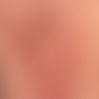 Psoriasis guttata: acute, "overnight", relapse of a small-focus psoriasis, following an acute, fe...