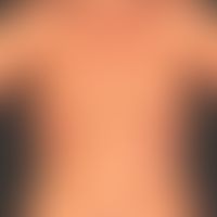 Psoriasis anularis: chronically active psoriasis vulgaris with anular psoriatic plaques, no pustu...