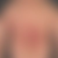 Psoriasis vulgaris chronisch-aktiver Plaque-Typ: neben langzeitig bestehenden psoriatischen Plaqu...