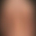 Psoriasis guttata: Mischbild zwischen der Psoriasis guttata mit zahlreichen "frischen" kleinherdi...