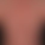 Psoriasis pustulosa generalisata: schwer verlaufendes Krankheitsbild mit Fieber, Arthralgien und ...