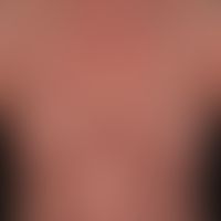 Psoriasis pustulosa generalisata: schwer verlaufendes Krankheitsbild mit Fieber, Arthralgien und ...