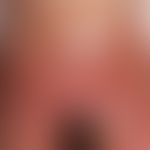 Psoriasis pustulosa generalisata. Eruption steriler Pusteln auf flächigen Erythemen im Bereich de...