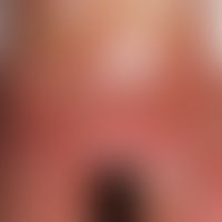 Psoriasis pustulosa generalisata. Eruption steriler Pusteln auf flächigen Erythemen im Bereich de...