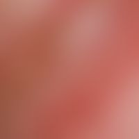 Psoriasis pustulosa generalisata: Detailaufnahme vom linken Oberschenkel.
