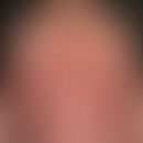 Psoriasis pustulosa generalisata: bei bekannter, bisher nur diskret ausgebildeter&nbsp;Psoriasis,...