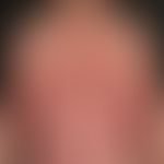Psoriasis pustulosa generalisata: bei bekannter, bisher nur diskret ausgebildeter&nbsp;Psoriasis,...