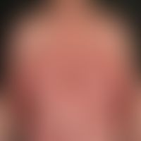 Psoriasis pustulosa generalisata: bei bekannter, bisher nur diskret ausgebildeter&nbsp;Psoriasis,...