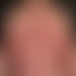 Psoriasis pustulosa generalisata: bei bekannter, bisher nur diskret ausgebildeter&nbsp;Psoriasis,...