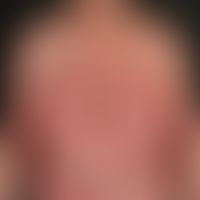 Psoriasis pustulosa generalisata: bei bekannter, bisher nur diskret ausgebildeter&nbsp;Psoriasis,...