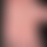 Pustulosis palmaris et plantaris: akut aufgetretene, disseminierte, 0,2-0,4 cm große, glatte gelb...