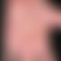 Pustulosis palmaris et plantaris: acutely occurring, disseminated, 0.2-0.4 cm large, smooth yello...