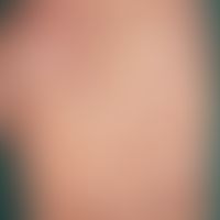 Pustulosis palmaris et plantaris: multiple, acute, disseminated, 0.2-0.4 cm large, smooth yellowi...