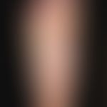 Pustulosis palmaris et plantaris: massive (sterile), schmerzhafte&nbsp;Pustulose der Fußsohlen na...