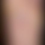 Pustulosis palmaris et plantaris: Viereck: gruppierte Pusteln, geringes kollaterales Erythem. Ein...