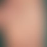 Pustulosis palmaris et plantaris: durch Viereck merkiert: frische und ältere Pusteln. Die beiden ...