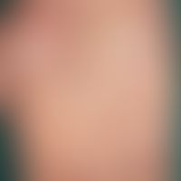 Pustulosis palmaris et plantaris: marked by square: fresh and older pustules. The two upper pustu...