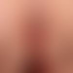 Psoriasis intertriginosa: inversely localised psoriasis with sharply defined red plaques and firm...