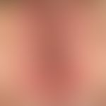 Psoriasis intertriginosa: inversely localized psoriasis (psoriasis inversa) with sharply defined,...