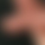 Psoriasis palmaris et plantaris (plaque type): blurred psoriatic plaque with rhagade on the finge...