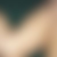 Incontinentia pigmenti, Typ Bloch-Sulzberger. Girlandenförmige Pigmentierung am Oberschenkel im V...