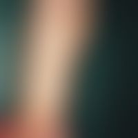 Incontinentia pigmenti, Typ Bloch-Sulzberger. Girlandenförmige Pigmentierung am Unterarm im Verla...