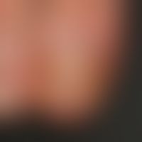 Psoriatic onychodystrophy: numerous so-called pits (pit-shaped depressions in the nail matrix). i...
