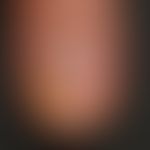 Oil stain psoriatic: circumscribed yellowish-brownish discoloration of the nail due to subungual ...