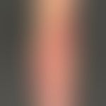 Psoriasis vulgaris chronisch-stationäre (Plaque-Typ): unbehandelte psoriatische Plaque am Ellenbo...