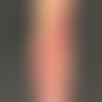 Psoriasis vulgaris chronisch-stationäre (Plaque-Typ): unbehandelte psoriatische Plaque am Ellenbo...