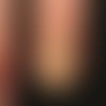 psoriasis of the nails: complete destruction of the nail matrix. missing cuticle. lateral nail wa...