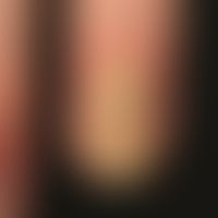 psoriasis of the nails: complete destruction of the nail matrix. missing cuticle. lateral nail wa...