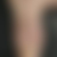 Psoriasis of the nails. single (only on the thumb), complete, crumbly onychodystrophy (psoriatic ...