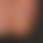 Psoriasis of the nails: circumscribed damage to the nail root with alteration of the cuticle, mar...