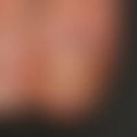 Psoriasis of the nails: circumscribed damage to the nail root with alteration of the cuticle, mar...