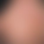 Psoriasis seborrhoischer Typ. Chronisch rezidivierende, scharf begrenzte, flächige, raue, z.T. mi...