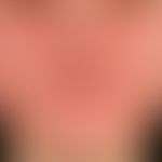 Psoriasis seborrhoischer Typ: seit mehreren Monaten ortskonstante, symmetrische, therapieresisten...