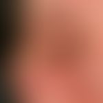 Psoriasis seborrhoischer Typ: seit mehreren Monaten ortskonstante, scharf begrenzte, therapieresi...