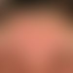 Psoriasis seborrhoischer Typ: seit mehreren Monaten ortskonstante und therapieresistente, nur ger...