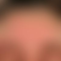 Psoriasis seborrhoeic type: for several months constant and therapy-resistant, only slightly elev...