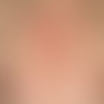 Psoriasis seborrhoischer Typ:&nbsp;Chronisch rezidivierende, scharf begrenzte, im Brustbereich ei...