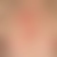 Psoriasis seborrhoeic type: Chronic recurrent, sharply defined red spots and plaques, which are l...