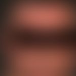 Psoriasis seborrhoischer Typ: seit mehreren Jahren rezidivierende, ortskonstante und therapieresi...
