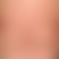 Psoriasis anularis: schubaktive&nbsp;Plaque-Psoriasis mit disseminierten, anulären&nbsp;und konfl...