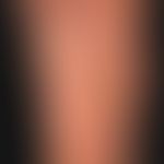 Psoriasis palmaris et plantaris: mixed type with keratotic plaques, dyshidrotic vesicles and pust...